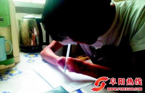 阜阳颍东区毁容小伙欲整容以圆大学梦