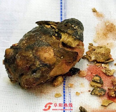 阜阳市人民医院采用微创手术为病患巧取巨型肾结石